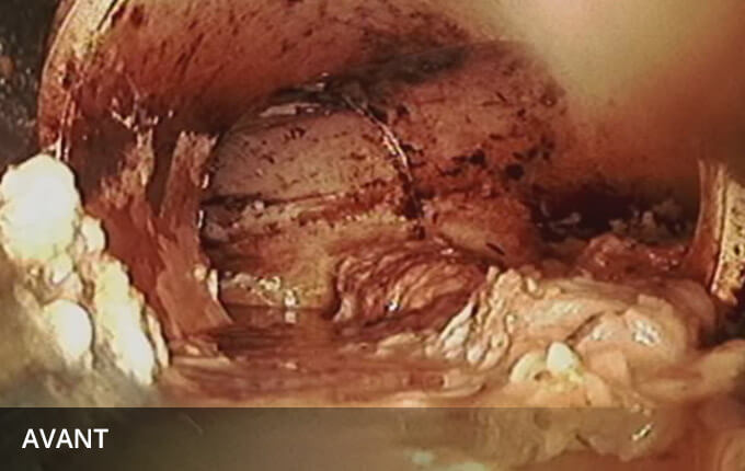 Débouchage de drain Repentigny.